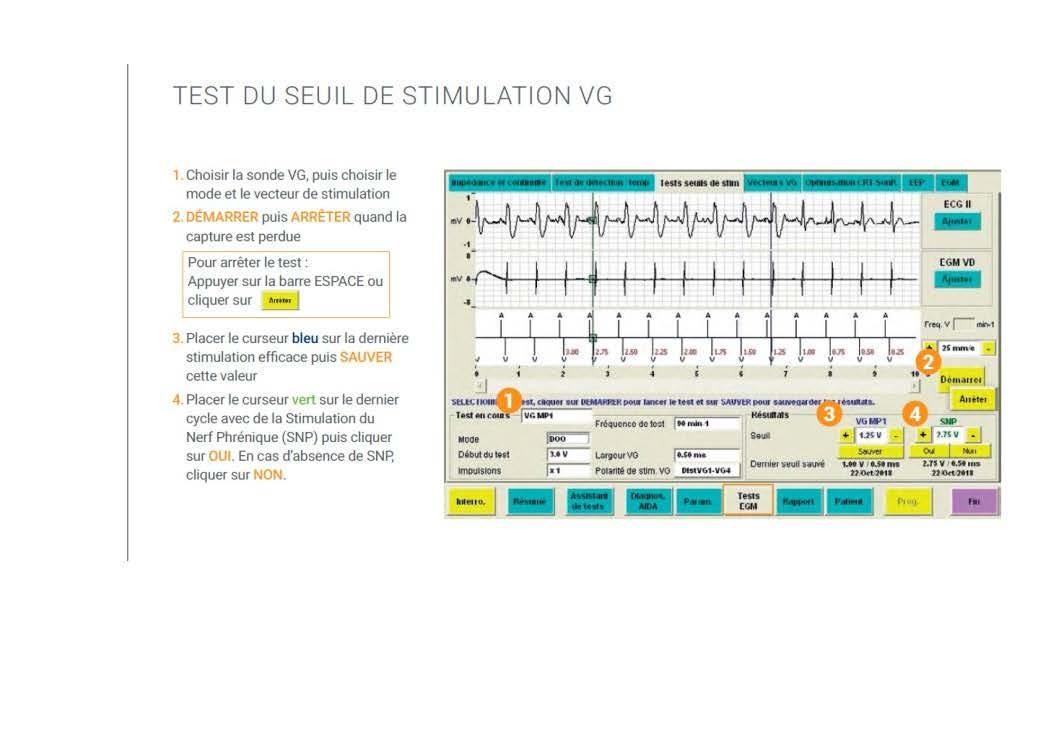2 2 1 2 fonctionnement des appareils en stimulation cardiaque les specificites des labos copie page 15
