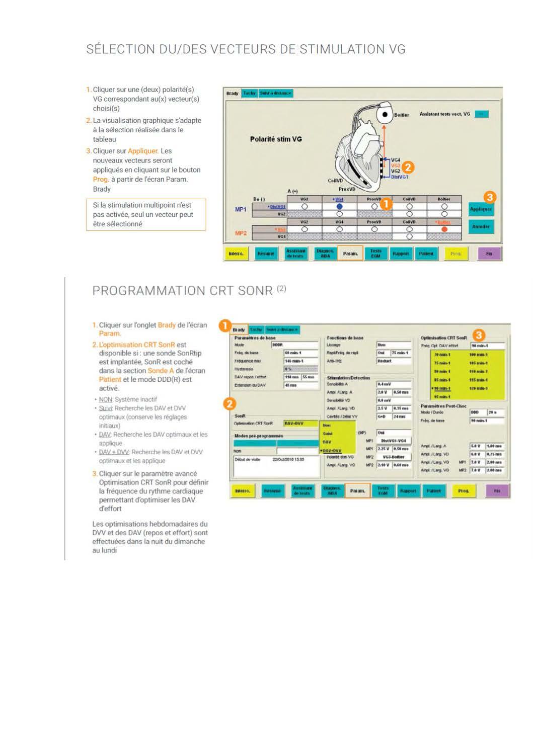 2 2 1 2 fonctionnement des appareils en stimulation cardiaque les specificites des labos copie page 22