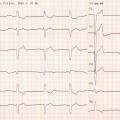 Cas clinique n°1 - Quel est votre lecture de l'ECG
