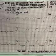 Sur quel territoire cet ECG présente il un sus décalage ?