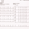 Ecg fa
