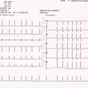 Ecg fa