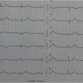 Me M-L est âgée de 87 ans. Elle est hypertendue et présente des lipothymies à répétitions avec chutes. Voici son ECG (FC 45/min). De quoi s'agit-il?