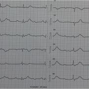 Me M-L est âgée de 87 ans. Elle est hypertendue et présente des lipothymies à répétitions avec chutes. Voici son ECG (FC 45/min). De quoi s'agit-il?