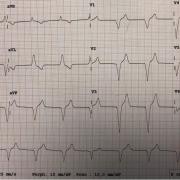 Mr A-A est âgé de 75ans. Il est porteur d’un DAI 2C SJM en prévention secondaire (TV sur CMI). Voici son ECG (FC 70/min) :