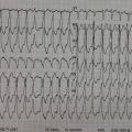 Mr S-F est âgé de 81 ans, hypertendu, ATCD de FA paroxystique et d’ablation de tachycardie de Bouveret à l’âge de 40ans. Il présente des palpitations persistantes depuis environ 6h avec TA à 11/6.  Voici son ECG (FC 180/min):