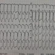 Mr S-F est âgé de 81 ans, hypertendu, ATCD de FA paroxystique et d’ablation de tachycardie de Bouveret à l’âge de 40ans. Il présente des palpitations persistantes depuis environ 6h avec TA à 11/6.  Voici son ECG (FC 180/min):