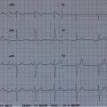 Mr G-M est âgé de 76 ans, il est porteur d’un RAC serré avec dyspnée d’effort et hospitalisé pour  bilan pré TAVI. Voici son ECG (FC 62/min) :