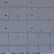 Mr G-M est âgé de 76 ans, il est porteur d’un RAC serré avec dyspnée d’effort et hospitalisé pour  bilan pré TAVI. Voici son ECG (FC 62/min) :