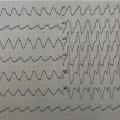 Mr J-B est âgé de 72 ans, il est porteur d’une CMD non ischémique FEVG 30% et consulte en urgence pour palpitations.  Voici son ECG ( FC 150/min) :