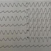 Mr J-B est âgé de 72 ans, il est porteur d’une CMD non ischémique FEVG 30% et consulte en urgence pour palpitations.  Voici son ECG ( FC 150/min) :