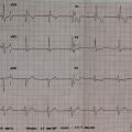 Mr J-S est âgé de 45 ans, il est diabétique. Il présente une douleur thoracique atypique avec malaise sans perte de connaissance. Voici son ECG (FC 65/min) :