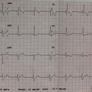 Mr J-S est âgé de 45 ans, il est diabétique. Il présente une douleur thoracique atypique avec malaise sans perte de connaissance. Voici son ECG (FC 65/min) :