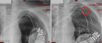 Fracture de sonde 1