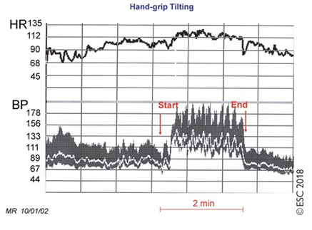 Manoeuvres syncopes graph