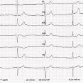 Me N-K est âgée de 63ans, elle présente les antécédants suivant : CMI et insuffisance rénale chronique, sous Tenormine. Voici son ECG, FC 38/min :