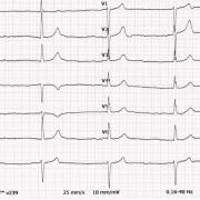 Me N-K est âgée de 63ans, elle présente les antécédants suivant : CMI et insuffisance rénale chronique, sous Tenormine. Voici son ECG, FC 38/min :