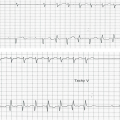 Mr M-G est âgé de 93ans. Il se présente dans un contexte de SCA avec palpitations.Voici son tracé enregistré au scope, FC 136/min.