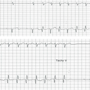 Mr M-G est âgé de 93ans. Il se présente dans un contexte de SCA avec palpitations.Voici son tracé enregistré au scope, FC 136/min.