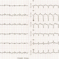 Mr M-L est âgé de 69ans. Ses antécédants sont les suivants :  cardiopathie rythmique avec FA persistante et FEVG 40%. Palpitations avec décompensation cardiaque. Sa fréquence cardiaque est de 148/min.