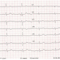 Me B-O, âgée de 93 ans, est hypertendue sous bisoprolol. Elle consulte dans le cadre de son suivi annuel, elle est asymptomatique. FC 50/min