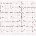 Me Z-Z est âgée de 80 ans, diabétique de type 2. Elle présente une asthénie avec des sensations de palpitations depuis 2 jours. Elle est sous isoprénaline pour bradycardie sévère. FC : 48/min