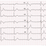 Me Z-Z est âgée de 80 ans, diabétique de type 2. Elle présente une asthénie avec des sensations de palpitations depuis 2 jours. Elle est sous isoprénaline pour bradycardie sévère. FC : 48/min