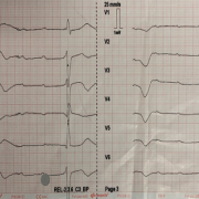 Mr Gu est âgé de 81ans, ces antécédants sont les suivants : néoplasie prostatique. Appel au SAMU pour syncope. FC 30/min. Il s'agit :