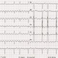 Mr M-H est âgé de 72ans, hypertendu, il présente des palpitations avec une insuffisance cardiaque (FEVG 35%.) FC 95/min