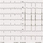 Mr M-H est âgé de 72ans, hypertendu, il présente des palpitations avec une insuffisance cardiaque (FEVG 35%.) FC 95/min