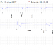 Toujours pour Mr T (implantation d’un MCI pour syncope) vous avez le tracé suivant, vous :