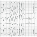 Me J-D est âgée de 97 ans, hypertendue, elle présente des  lipothymies et une asthénie. K+ à 4,2 mmol/l.Voici le tracé extrait du scope :  RR de base à 1500ms. QTc 530ms