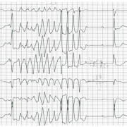 Me J-D est âgée de 97 ans, hypertendue, elle présente des  lipothymies et une asthénie. K+ à 4,2 mmol/l.Voici le tracé extrait du scope :  RR de base à 1500ms. QTc 530ms