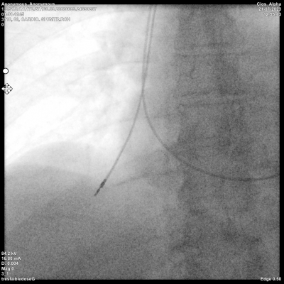 Sonde transfixiante