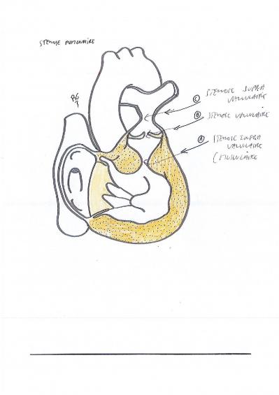 Stenose pulmonaire