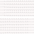Me T-B est âgée de 69 ans, elle présente des palpitations. Ses antécédents sont les suivants : ablation de la voie lente en 2016. FC 150/min