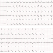 Me T-B est âgée de 69 ans, elle présente des palpitations. Ses antécédents sont les suivants : ablation de la voie lente en 2016. FC 150/min