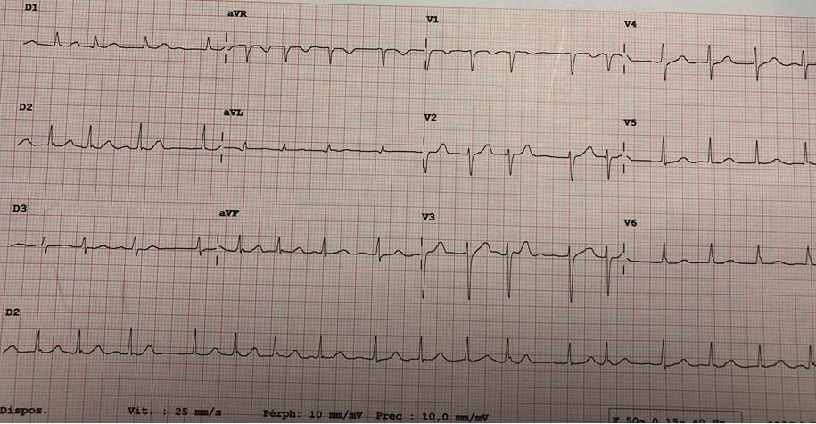 Quiz ECG : troubles du rythme et de la conduction