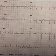 Me M-E est âgée de 61 ans et présente des palpitations. Voici son ECG (FC 102/min), quelle est la tachycardie sur cet ECG?